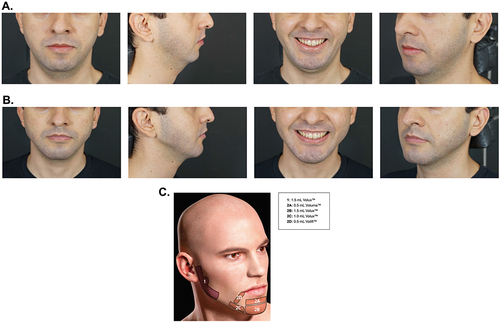 Figure 8 Case example of Caucasian male patient 32 years of age treated for aesthetic concerns in the lower face and neck (A) before treatment and (B) 60 days after filler treatment to address structural bone deficiency. The patient received hyaluronic acid injections (Juvederm® Volux™, Voluma™, and Volift™; Allergan Aesthetics, an AbbVie Company, Irvine, CA) in the lower face according to the schematic shown in (C). Photos courtesy of D. Coimbra, MD.
