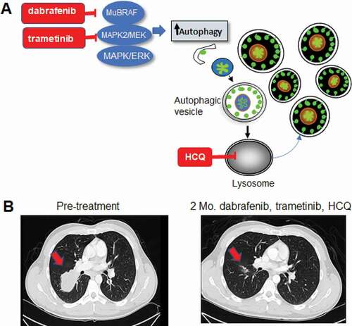 Figure 1. Combined BRAF, MAP2K/MEK and autophagy inhibition in BRAF mutant melanoma. (A) Schematic of concurrent targeting of the MAPK pathway and autophagy. Mu: Mutant. (B) Chest CT images of a stage IV BRAF mutant melanoma patient treated on the BAMM trial with dabrafenib, trametinib and hydroxychloroquine (HCQ). Mo.: Months. Arrow: melanoma metastases to the lung.