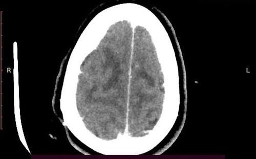 Figure 3 CT head angiography showing no evidence of filling defects in the dural venous sinuses.