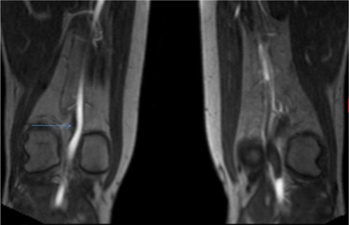 Figure 2 Flash 3D coronal T1-weighted post-contrast magnetic resonance image of bilateral knees.
