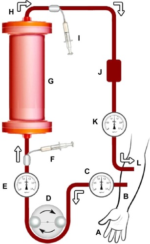 Figure 1 Schematic diagram of proposed extracorporeal viral antibody column (EVAC), an auxiliary therapy to reduce blood viral titers when treating viral infections in the blood by removing viral antigens and toxins from the bloodstream.