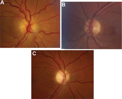 Figure 1 Fundus photo of the right and left eye.