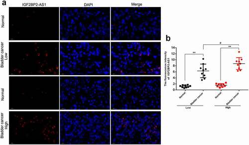 Figure 8. The IGF2BP2-AS1 expression was determined by FISH in low-grade bladder cancer tissues, high-grade bladder cancer tissues, and adjacent normal tissues. ** p < 0.01, # p < 0.05.