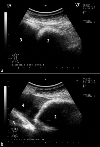 Figure 6. Ultrasonograms of the reticulum in a healthy camel. It appeared as a half-moon-shaped structure with an even contour. Images were taken at the level of the right paramedian region just behind the sternal pad. Image (a) was taken during reticular relaxation while image (b) was taken during reticular contraction. 1 = diaphragm; 2 = Reticulum; 3 = Ruminal sac; 4 = free peritoneal fluid; Ds = dorsal; Vt = ventral.