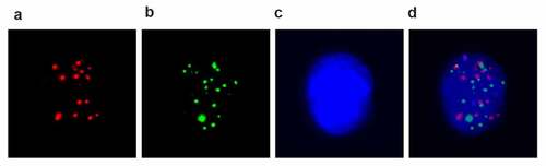 Figure 1. EMT phenotypes of CTCs were detected by the RNA in situ hybridization in pancreatic cancer patients. A: Fluorescence microscopy images show three types of CTCs with positive expression of epithelial markers (EpCAM and CK8/18/19, red dots); B, mesenchymal markers (Vimentin and Twist, green dots); C, DAPI stained nuclear; D, biphenotypic markers; Pictures were taken in immunofluorescence microscope by 40x magnification. CTC, circulating tumor cells; DAPI, 4′,6-diamidino-2-phenylindole (DAPI).