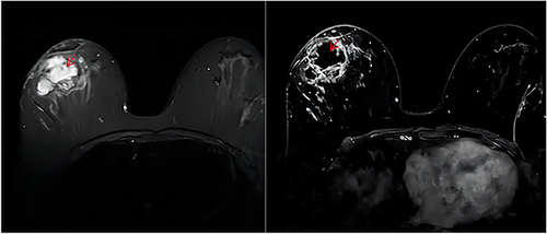 Figure 2 GLM with multiple irregular abscess formation (left T2WI, right T1W1). The red arrow indicates the location of the abscess cavity. High signal in T2W1, low signal in T1W1.