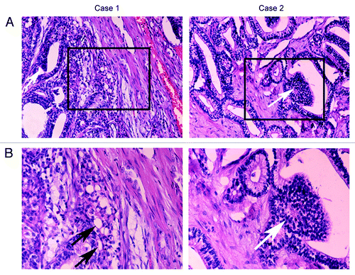 Figure 2. H&E staining of two samples. (A) H&E stained section from the surgical resections showed well-differentiated glands and scant stroma. The glands were consisting of irregular tubular structures lined with pseudostratified columnar epithelium, and typical squamoid morules (White arrows) were found. (B) The stroma consisted of cytologically bland fibroblast-like spindle cell without sarcomatous features. The subunclear and supranuclear vacuolization was occasionally observed (Black arrows).