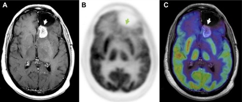 Figure 6 18F-FDG PET diagnosis of pseudoprogression.Notes: Patient with a history of glioblastoma, status post-resection, now after treatment with total dose of 60 Gy in 2-Gy fractions presents for a follow-up, 1 month after radiation therapy. MRI (A) demonstrates enhancement posterior to the prior resection cavity in the left frontal lobe (arrowhead). However, the patient showed clinical improvement, and therefore an 18F-FDG PET scan was done to assess for tumor progression. On PET (B), no abnormal areas of increased 18F-FDG uptake in the region of MRI contrast enhancement were identified (C), thus additional therapy was deemed not indicated; the patient was monitored on follow-up contrast-enhanced MRI scans, which were negative. Thus, PET scan was helpful in differentiating pseudoprogression from true progression. Adapted with permission from Lippincott Williams and Wilkins/Wolters Kluwer Health: Oborski MJ, Laymon CM, Lieberman FS, Mountz JM. Distinguishing pseudoprogression from progression in high-grade gliomas: a brief review of current clinical practice and demonstration of the potential value of 18F-FDG PET. Clin Nucl Med. 2013;38(5):381–384.Citation56 Copyright © 2013. Promotional and commercial use of the material in print, digital or mobile device format is prohibited without the permission from the publisher Lippincott Williams and Wilkins. Please contact journalpermissions@lww.com for further information.Abbreviations: FDG, 2-fluorodeoxyglucose; MRI, magnetic resonance imaging; PET, positron emission tomography.