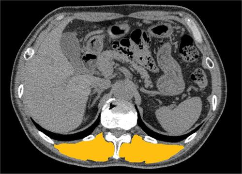 Figure 1 Representative chest computed tomography (CT) image used to measure the cross-sectional area of erector spinae muscles (ESMCSA). The manually selected area (yellow) is used to measure ESMCSA using the computer software, Image J.