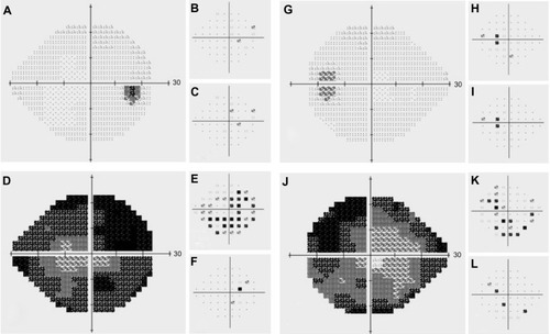 Figure 3 Results of right (A–F) and left (G–L) white-on-white perimetry (A–C and G–I) and blue-on-yellow perimetry (D–F and J–L). Gray-tone scale (A, D, G, and J), total deviation map (B, E, H, and K) and pattern standard deviation map (C, F, I, and L) for white-on-white and blue-on-yellow perimetry. Note that blue-on-yellow perimetry captured the visual field abnormalities more effectively than white-on-white perimetry.