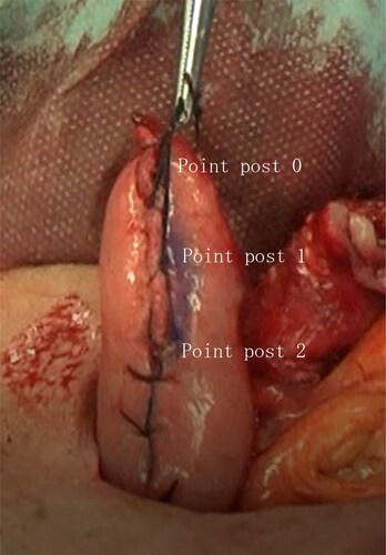 Figure 3. The gastric tube is shown after raising it to the cervical site through the post sternal route. Point post 0, post 1, and post 2 are shown at the tip, 2 cm to the anal side, and 4 cm to the anal side of the tip, respectively, are shown.