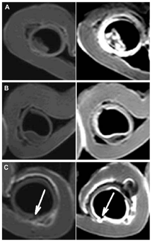 Figure 6 Transverse magnetic resonance images of three diseased tissue models before (left column) and after (right column) contrast enhancement by the nebulized lipid-stabilized contrast formulation. (A) Intraluminal protrusion, (B) submucosal nodule, and (C) submucosal crater.