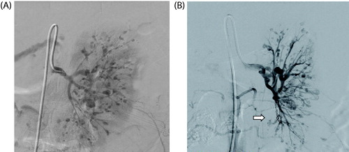Figure 4. (A) Angiogram of the left kidney showing multiple microansurysms. (B) Coil placement in a renal artery branch feeding into the hemoatoma [white arrow].