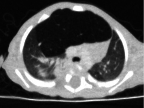 Figure 2 Thorax computed tomography showing that the right middle lobe is overinflated and herniated to the left side. Segmental atelectasis is seen in the right lower lobe.