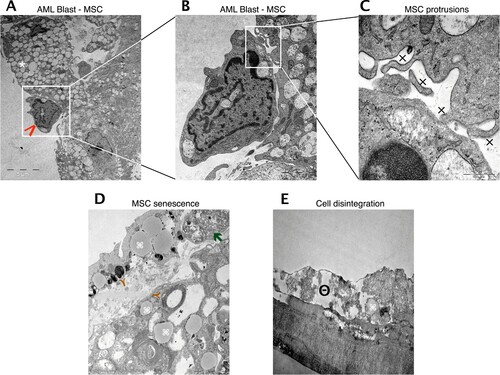 Figure 6. Reciprocal stimulation of human BM MSC in co-culture with AML cells. Representative electron microscopy images of co-cultured MSC and AML cells. (A) Tight cell to cell collocation of MSC (white asterisk) and AML blast (red arrow; AML sample 23) recognized in co-culture conditions after two weeks. A remarkable amount of secretory vesicles can be identified within the MSC cytoplasm. In higher resolutions (B, C) multiple protrusions (x) were obvious, but no evidence of tight junctions. (D) MSC in mono-culture after one week with obvious appearance of lipid inclusions (brown Y), myelin like inclusions (command sign) and phagocytes (green arrow), indicating senescence. (E) MSC in mono-culture after two weeks with cytoplasmic dissolution, indicating cell disintegration (minus symbol inside a circle).