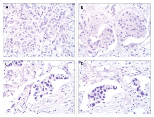 Figure 3. The immunohistochemistry results showed PD-Ll and PD-1 expression of the tumor sample (formalin-fixed paraffm-embedded specimens) obtained from Case 1 patient with a proportion score of less than 1% (A and B), from Case 2 patient also with a proportion score of less than 1% (C and D) at a magnification of 200.