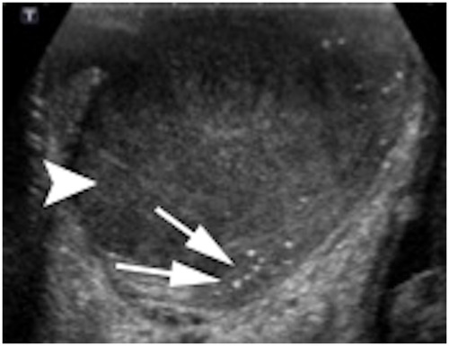 Figure 2 Testicular mass in the background of microlithiasis: homogeneous large oval hypoechoic intratesticular mass lesion with surrounding microlithiasis.