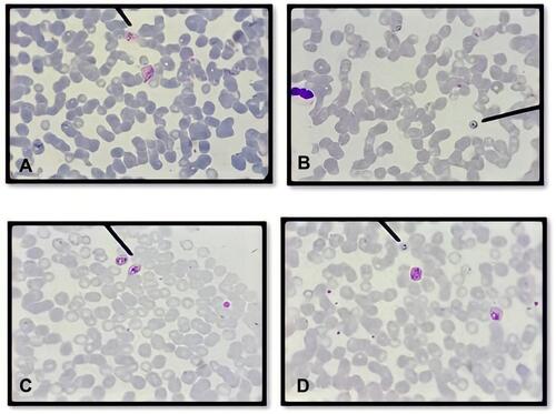 Figure 1 Species of Plasmodium identified using Giemsa stain on the day of blood collection. (A) Plasmodium vivax; (B) Plasmodium falciparum; (C) Plasmodium ovale; (D) mix infection (Plasmodium falciparum and Plasmodium vivax) were identified in donor blood samples. All the parasites show normal morphology characterized by regular ring form, normal volume of cytoplasm and no halo formation both in trophozoite and gametocyte stages.