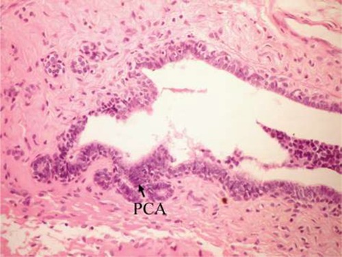 Figure 6 Photomicrograph of breast section of DMBA-administered control rat showing PCA (H and E, ×400).