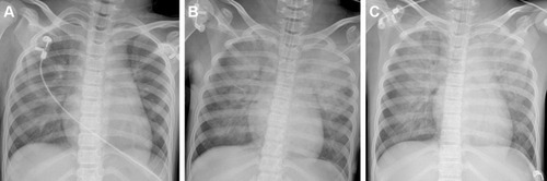 Figure 1 Series of chest X-rays: (A) on admission; (B) 48 hours post-ECMO; and (C) before weaning.