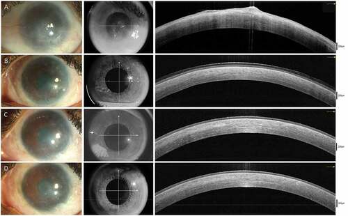 Figure 4. This is a representative collage of serial preoperative (A) and postoperative (B,C,D) clinical images and corresponding OCT line scans that illustrate the improvement in corneal clarity post-SLET (left eye)
