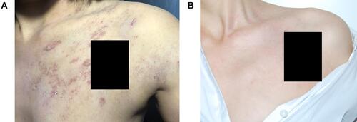 Figure 1 Skin lesions of patient 1 (tattoo was masked by black bars). (A) Erythematous papules and plaques on the left chest and shoulder. (B) Skin lesions healed after topical corticosteroid treatment.