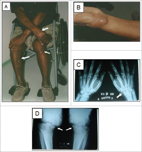Figure 1. A sixty-one-year-old patient with disseminated sporotrichosis. (A) Multiple scars are visible on the limbs (arrows), where cutaneous lesions were previously present. (B) Inflammatory cyst on the left wrist. The first 3 isolates were collected from the wrist lesion, by puncture with fine needle at different time points over a 6-month period. C-D) Radiographs showed severe lytic lesions and sclerosis at the left wrist and knees (arrows).