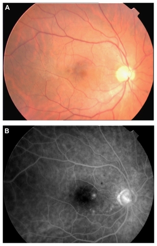 Figure 2 (A) Fundus photograph 1 month after the second vitrectomy with internal limiting membrane peeling; (B) fundus fluorescein angiogram showing two retinal pigment epithelium leak points in the juxtafoveolar area.
