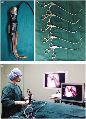 Figure 1. Airtraq® laryngoscope has an anatomically shaped blade and can be connected with a video camera system (A). A set of curved instruments designed by our team (B). In operation, Airtraq® was connected with an endoscopic video system and, thus, the images of the larynx were displayed on a monitor. The surgeon held Airtraq® with the left hand and the instrument with the right hand (C).