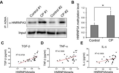 Figure 5 HNRNPA3 dimethylation and its correlation with inflammatory factors. (A) Greatly increased asymmetric arginine dimethylation of HNRNPA3 proteins in CP tissues. Protein asymmetric arginine dimethylation were quantitatively assessed by immunoprecipitation using antibodies targeting ADMA, followed by Western blot with the antibodies specifically recognizing HNRNPA3 (B). Relative HNRNPA3 dimethylation levels among four CP patients were compared with the control group containing four other cholangiocarcinoma patients. (C, Dand E) The positive correlation of HNRNPA3 asymmetric arginine dimethylation levels with the major inflammatory factors in serum of CP patients. Serum TGF-b, TNF-a and IL-6 levels in CP patients were analyzed via ELISA method. *P<0.05.