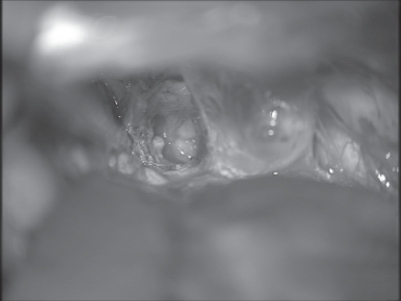 Figure 5 Intraoperative photograph after pterional approach from the right-hand side and resection of the cavernoma. The suction tube touches the beginning of the left optic nerve. One can look through the right-hand optic nerve, because it is extremely thin.