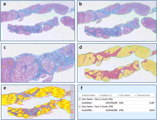 Figure 4. Digital image analysis steps performed on the image of a chronic hepatitis C patients’ biopsy interpreted as Ishak F6 by the pathologist, (a) original image, (b) region-of-interest (ROI) selection (bordering the specimen area), (c) manual thresholding (white voids within the sample represent steatosis), (d) fibrosis and parenchyma areas are converted into a binary colored overlay, (e) feature identification and extraction, (f) quantification of fibrosis and parenchyma areas, trichrome proportionate area is calculated as 0.287/(0.287 + 0.619) × 100% = 31.68%.