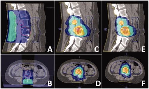 Figure 1. Different radiotherapy treatment plans for one patient. (A, B) Sagittal and transverse image of conventional EBRT treatment plan. (C, D) Sagittal and transverse image of SBRT treatment plan without sparing of surgical area. (E, F) Sagittal and transverse image of SBRT treatment plan with sparing of the surgical area. The yellow line denotes the surgical area. The dark blue area receives 8 Gy, the turquoise area 9 Gy, the yellow area 16.2 Gy and the orange area 18 Gy.