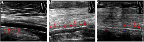 Figure 3. Vascular ultrasound of the lower extremities (there was no evident abnormality in the diameter of the bilateral lower limb artery. However, the walls were rough with multiple hyperechoic and hypoechoic plaques. Extensive calcification of the arterial media was detected. A: right femoral artery; B: right posterior tibial artery; C: right dorsalis pedis artery; red arrows show calcification areas of the arterial media).