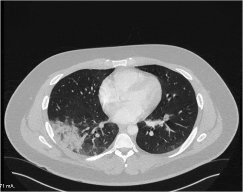 Figure 2. CT angio pulmonary with contrast showing confluent patchy right lower lobe basal segment consolidation representing mostly pulmonary infarction