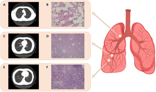 Figure 1 Chest computed tomography (CT) for the nodules in the lung lobes and the hematoxylin-eosin staining revealed the lung adenocarcinoma cells in the three primary sites (100µm). Three light red circles show the schematic location of the nodules. (A) and (B) for the nidus in the right upper lobe carrying EGFR 19del, (C) and (D) for the nidus in the right middle lobe carrying EGFR 20ins, and (E) and (F) for the nidus in the right middle lobe carrying ROS1 fusion.
