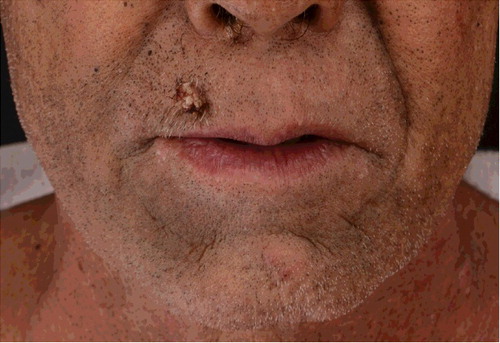 Figure 2. Chloracne lesions on face. Verruca-like keratoses above the right upper lip.