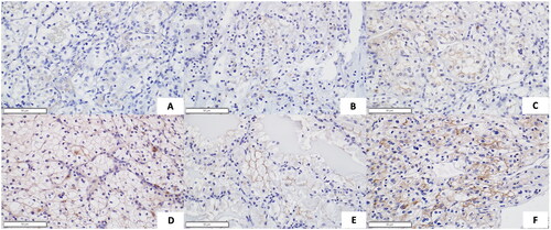 Figure 1. TMEM27 immunohistochemistry staining intensities starting from weak to strong membranous positivity (A-F). (A) shows the weakest staining (0.5) while (F) has the strongest membrane staining (3). Each image is at 40X. Scale bar represents 50 µM.