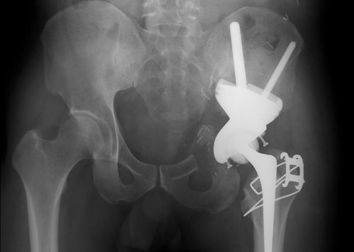 Figure 6. Postoperative plain radiograph showing satisfactory alignment of the custom pelvic prosthesis.