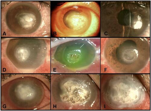 Figure 1 3 examples of green thermal laser application for resistant infectious keratitis (IK). Case 1 (A–C) had a bacterial IK, with a 1 mm height hypopyon level. Pre-treatment (A), post-laser (B), and after complete healing (C). Case 2 (D–F) had a fungal IK, with a 3 mm hypopyon level. Pre-treatment (D), immediately post-laser with stained cornea (E), and after complete healing (F), with residual corneal opacity. Case 3 (G–I) had mixed bacterial and fungal dense central infiltration with a flat anterior chamber (G), Post-laser (H), and after amniotic membrane transplantation (I).