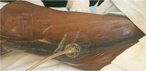 Figure 2 Application of VAC dressing on the wound.