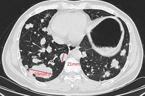 Figure 3. Chest CT in Apr 2019 (4 months after fruquintinib)