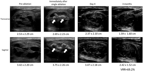 Figure 2. Sonographic pictures showing the changes in echogenicity and nodule dimensions following single treatment for the first 3 months. The thick arrows indicate the presence of microbubbles or hyperechoic marks within the target nodule which are only evident immediately after ablation.