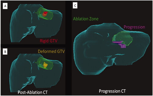 Figure 5. Importance of a deformable registration model use for assessing ablation margins. (A) 3 D CT reconstructionu using a rigid registration model. Gross tumor volume (GTV, red) is depicted onto the postablation CT maps within the ablation zone (green area); (B) 3 D CT reconstruction using a deformable registration model depicting GTV (yellow) in close contact with the ablation zone margin (green area) caudally, reflecting insuficient ablation margins (2 mm) at that region; (C) 6-month postablation 3 D CT reconstruction using a deformable registration depicting local tumor progression (purple area) and the caudal aspect of the ablation zone (green area), which was deemed to have insufficient ablation margins per biomechanical deformable registration model. Courtesy: Brian Anderson, PhD and Kristy Brock, PhD.