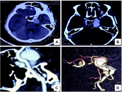Figure 1 CT and CTA images before treatment.