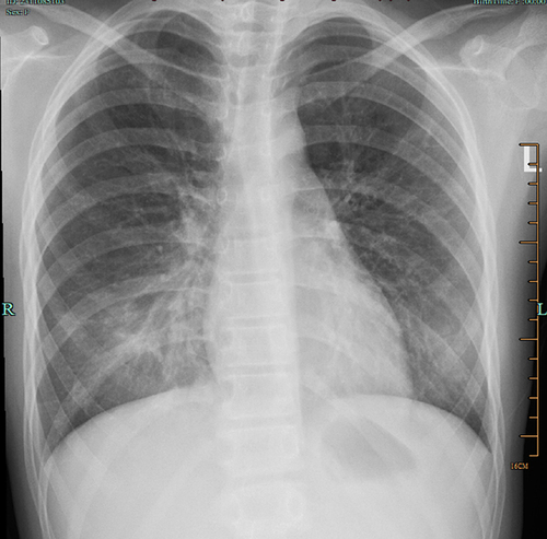 Figure 3 X-ray on the eighth day of admission: the two pneumonia cases were significantly absorbed.