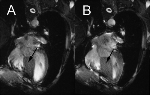 Figure 3 Magnetic resonance imaging of the heart in diastole A) and systole B) showing a severely hypertrophic interventricular septum (arrow) with a width of 3.5 cm in diastole and 3.9 cm in systole, a left ventricular-free wall of normal thickness, and a deformed chest wall with its left side running nearly parallel to the septum and free wall.