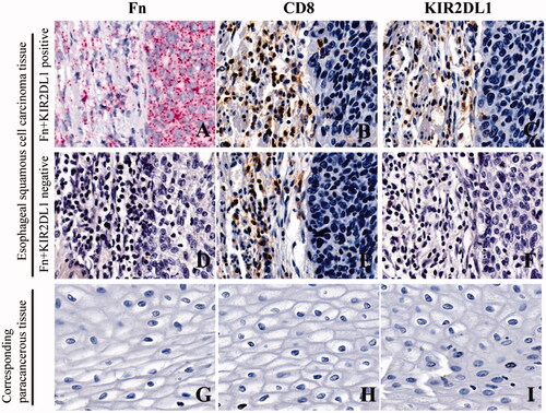 Figure 4. Fn infection and KIR2DL1 expression on the surface of CD8+ T cells in ESCC and adjacent tissues (400×). (A,D,G) Representative RNAscope images of Fn infection (16S rRNA); (B,E,H) Representative immunohistochemical images of CD8+ T cell infiltration; (C,F,I) Representative immunohistochemical images of KIR2DL1 expression.