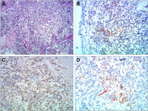Figure 1 Histochemical and immunohistochemical examinations of the tumors from our cases.