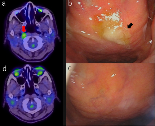 Figure 1 PET/CT and Laryngeal endoscopy findings before and after antibiotic therapy.